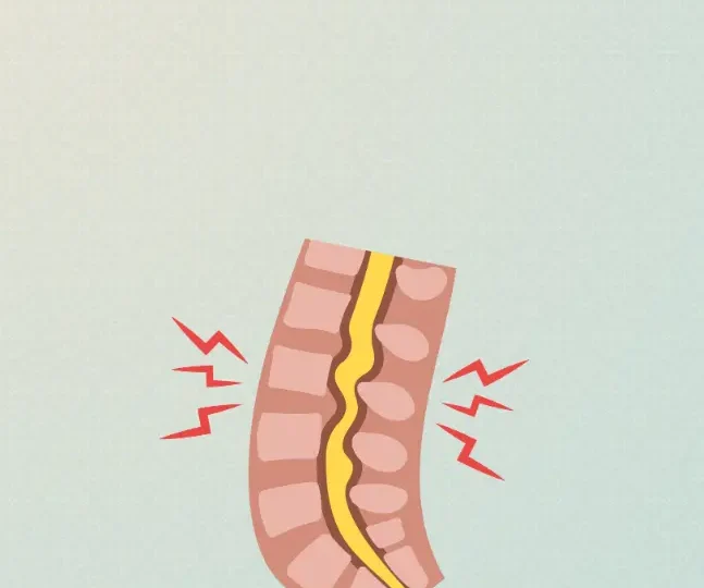 What is Spinal Stenosis (1)