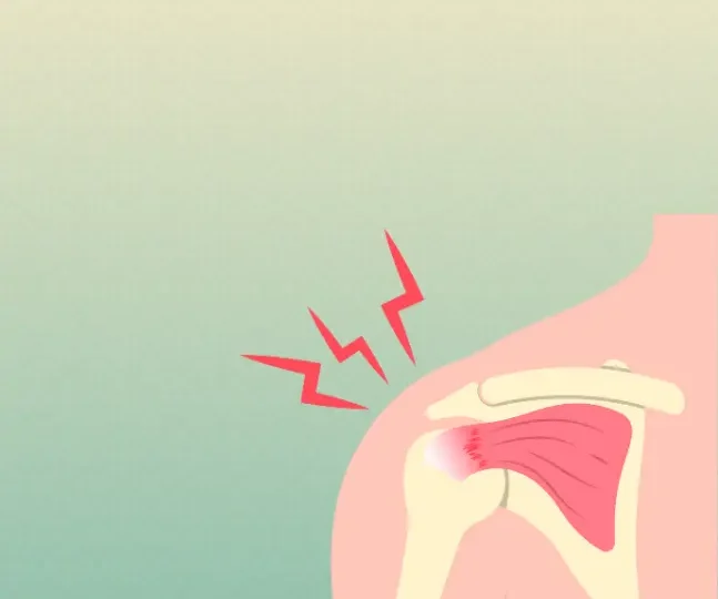 What are Repetitive Strain Injuries (1)