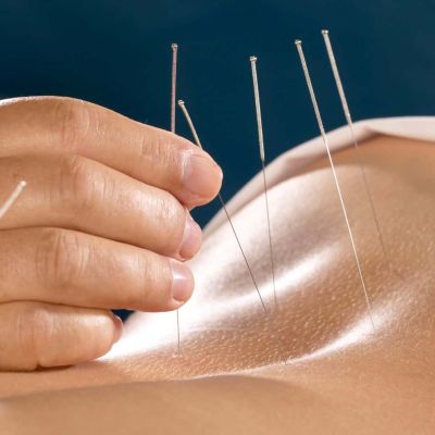 Anatomical Acupuncture in Ottawa