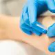 dry needling