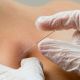 dry needling