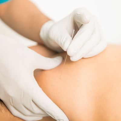 Dry Needling in Ottawa