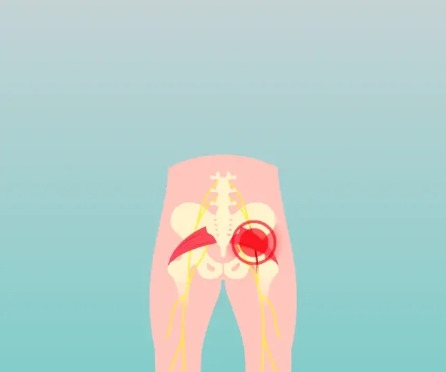 Piriformis Syndrome