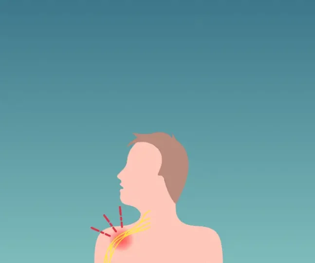 Thoracic outlet syndrome