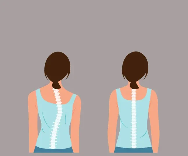 Has Your Child Been Screened For Scoliosis