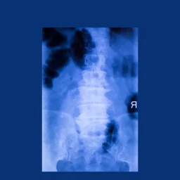 Spinal arthritis blog curavita