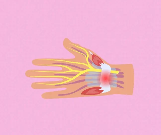 Physiotherapy can play a significant role in managing carpal tunnel syndrome effectively. Learn how we can help. CURAVITA Ottawa