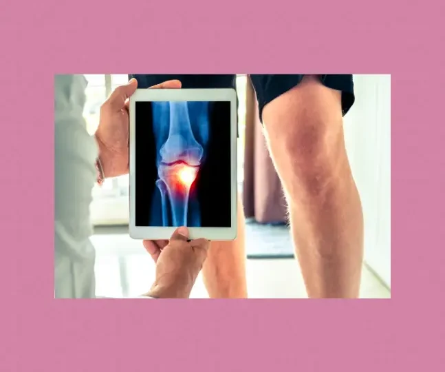 Chiropractic care Ottawa for knee osteoarthritis